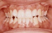 postura denti